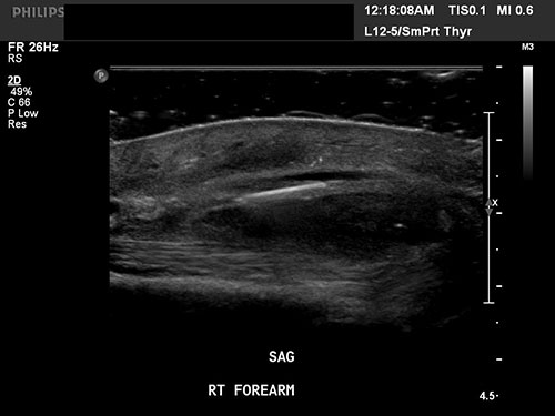 Ultrasound Lab scan of human arm with broken needles